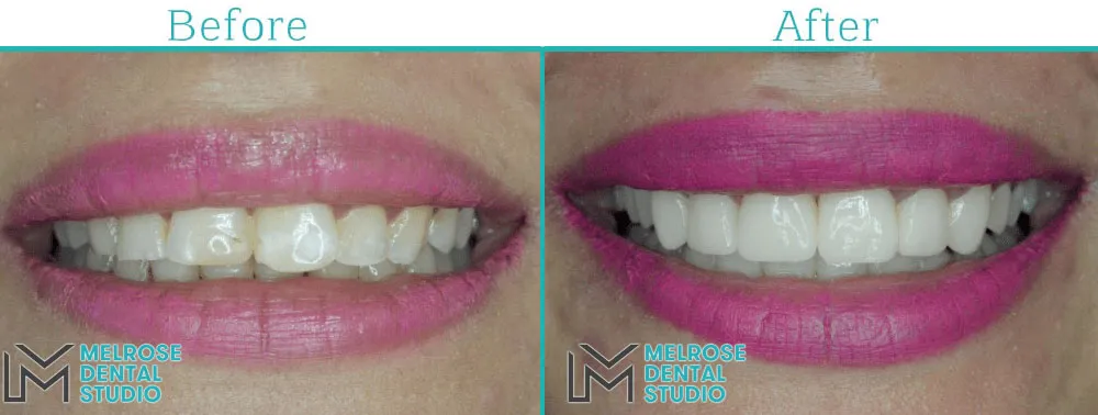 Smile makeover with porcelain veneers at Melrose Dental Studio, before and after, case 2